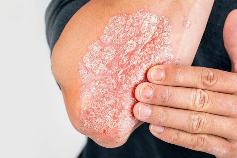 Các bệnh về Da liễu