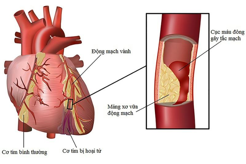 Các bệnh về tim mạch